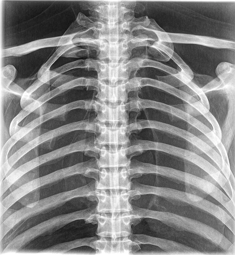 Röntgen-Thorax