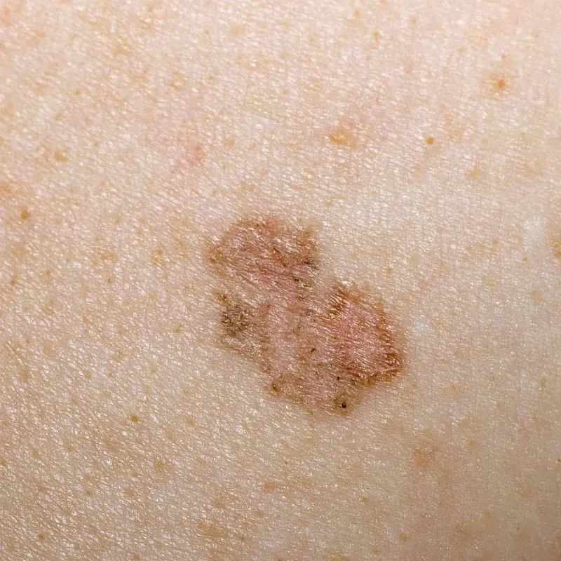 LuxaScope CCT Dermatoskop