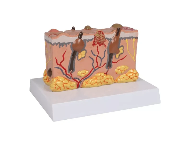 Pathologisches Hautmodel