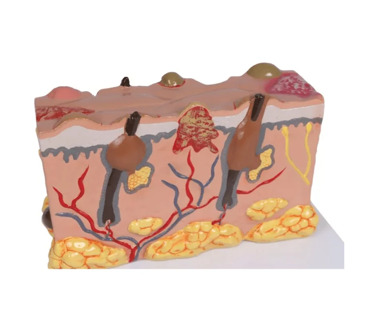 Pathologisches Hautmodel