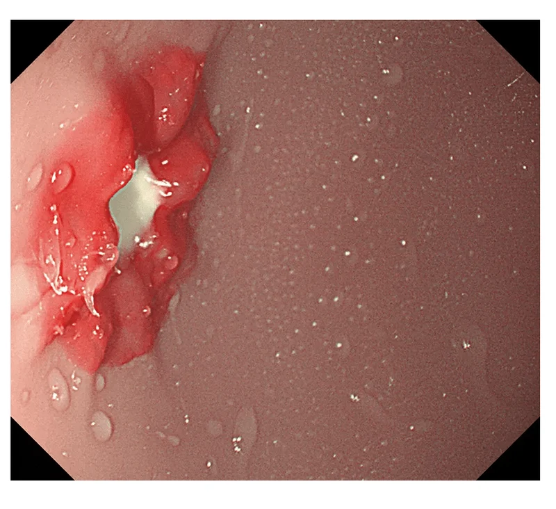 OGD-(Oesophago-Gastro-Duodenoskopie-)Simulator