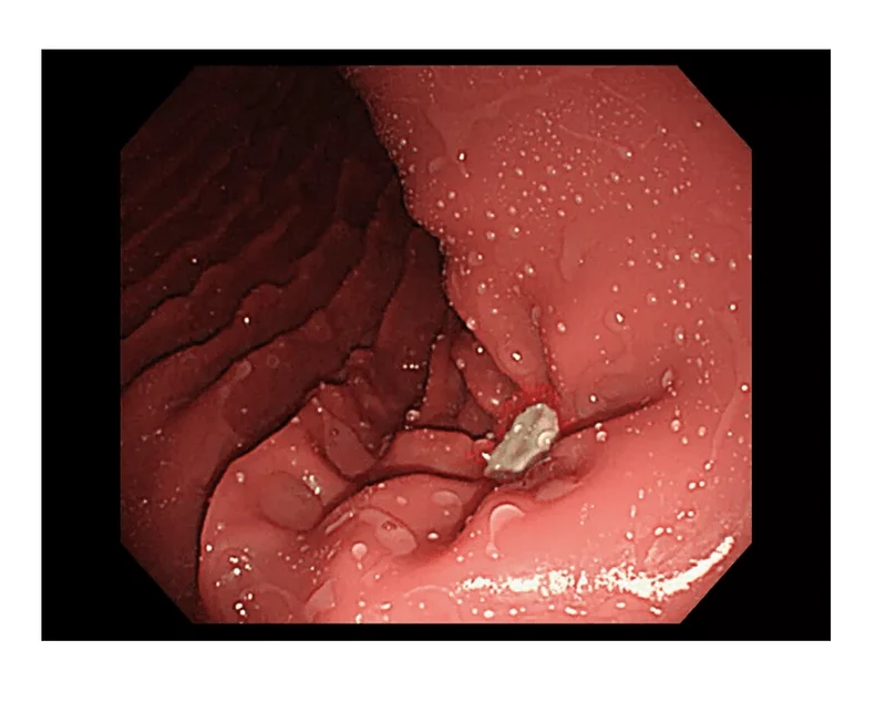 OGD-(Oesophago-Gastro-Duodenoskopie-)Simulator