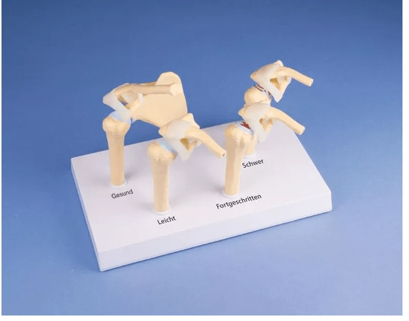4-Stadien-Osteoarthritis (OA) Schulter