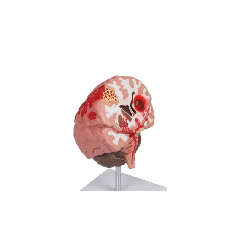 Pathologien des Gehirns, lebensgröße