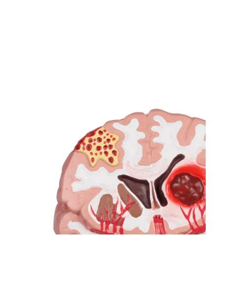 Pathologien des Gehirns, lebensgröße