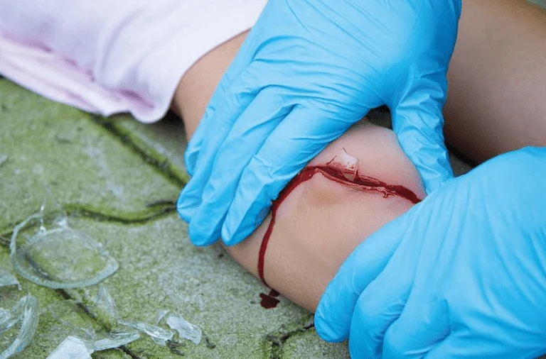Wundmoulage Schnittwunde mit Glassplitter