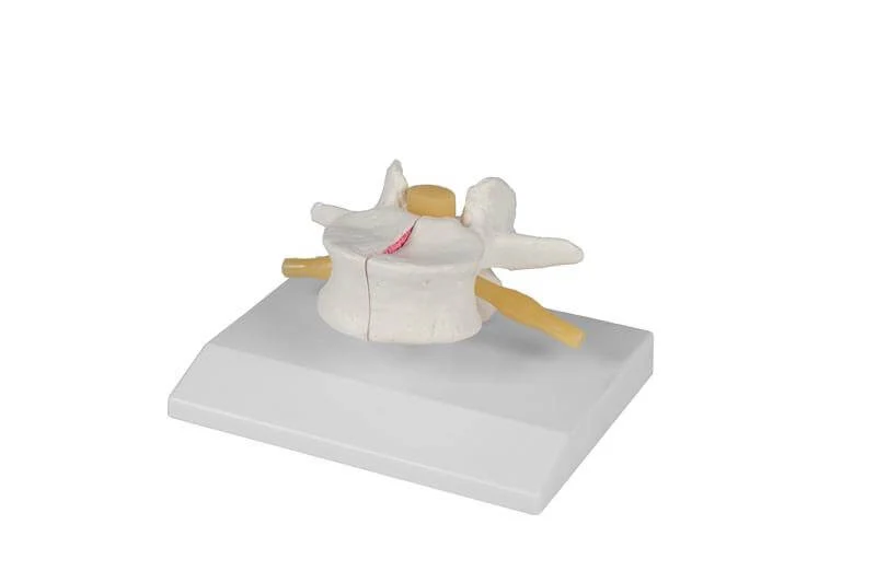 Lendenwirbel Modell Osteoporose 2x vergrößert | Magnetisch zerlegbar