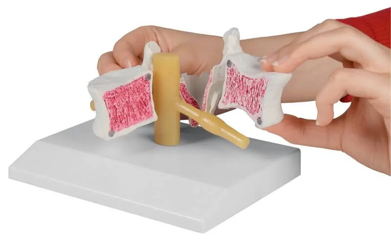 Lendenwirbel Modell Osteoporose 2x vergrößert | Magnetisch zerlegbar