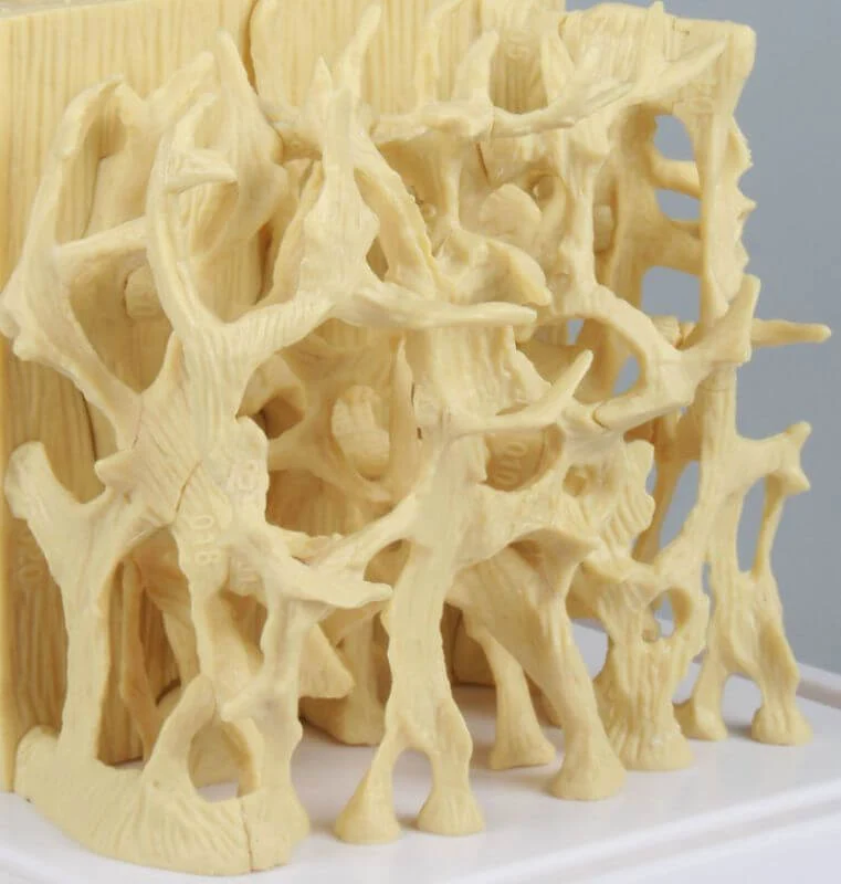 Knochenmodell gesund vs. osteoporotisch