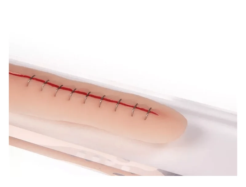 OP-Wunde 22 cm