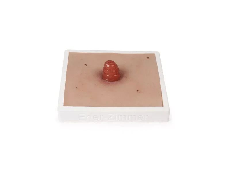 Wundmoulage Ileostoma, inkl. Stativ