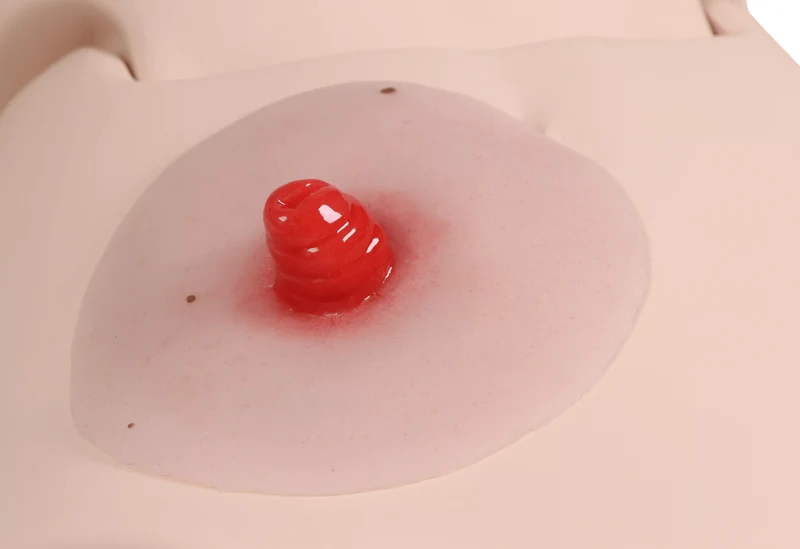 Wundmoulage Ileostoma, selbsthaftend