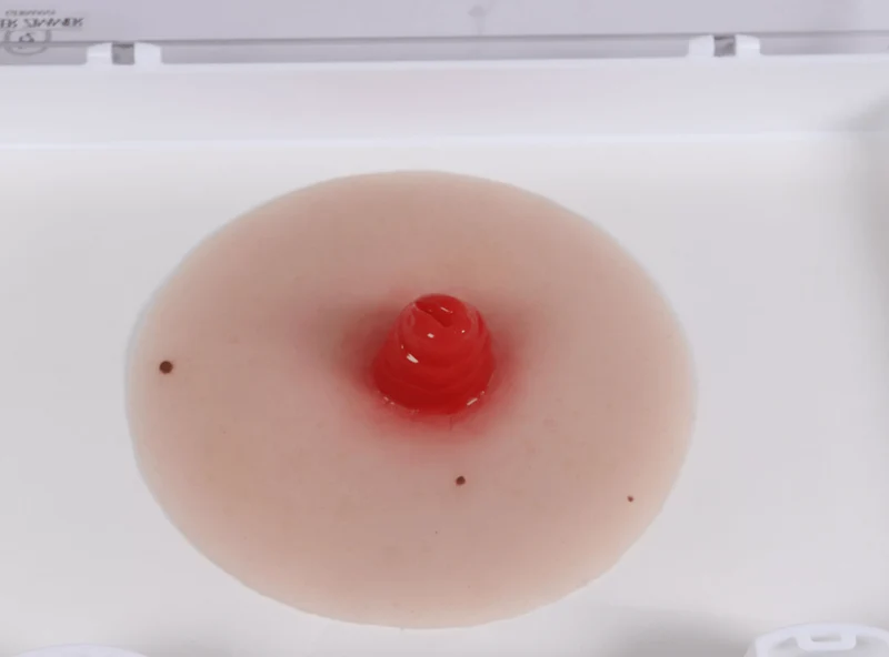 Wundmoulage Ileostoma, selbsthaftend