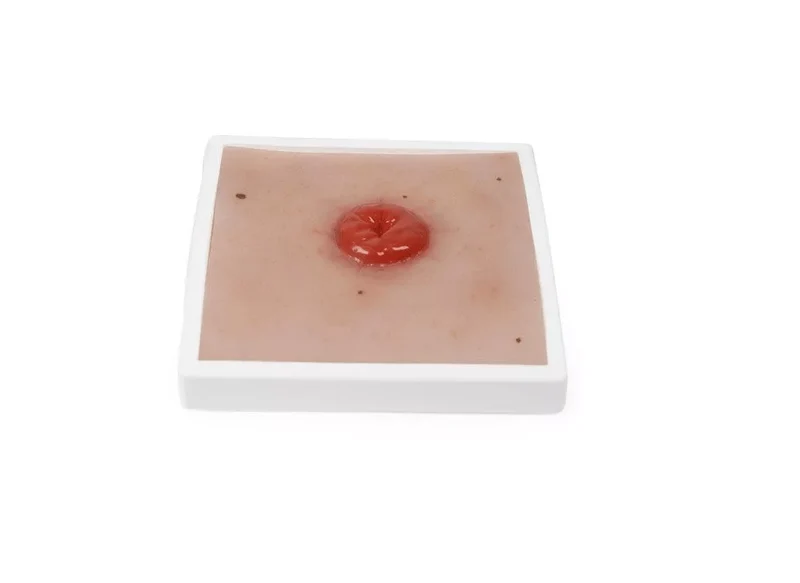 Wundmoulage Kolostoma, inkl. Stativ