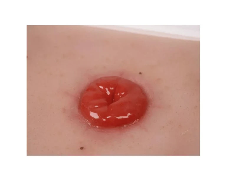 Wundmoulage Kolostoma, inkl. Stativ
