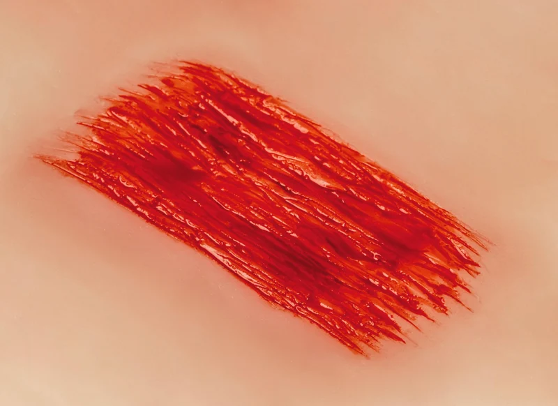 Wundmoulage Schürfwunde
