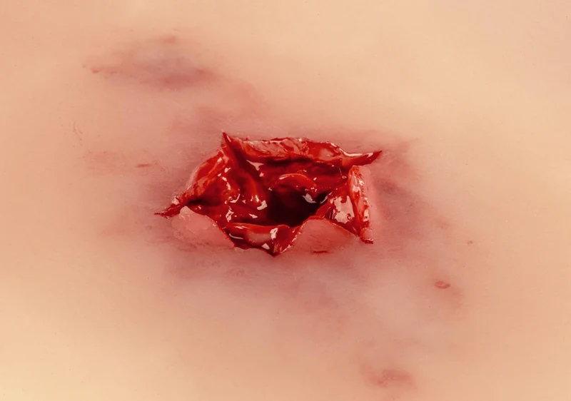 Wundmoulage Schuß Austrittswunde