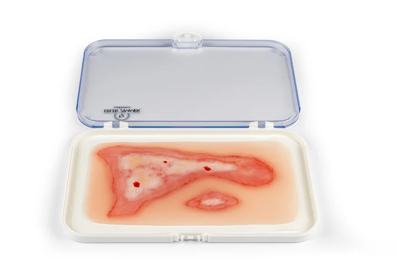 Wundmoulage Verbrühung
