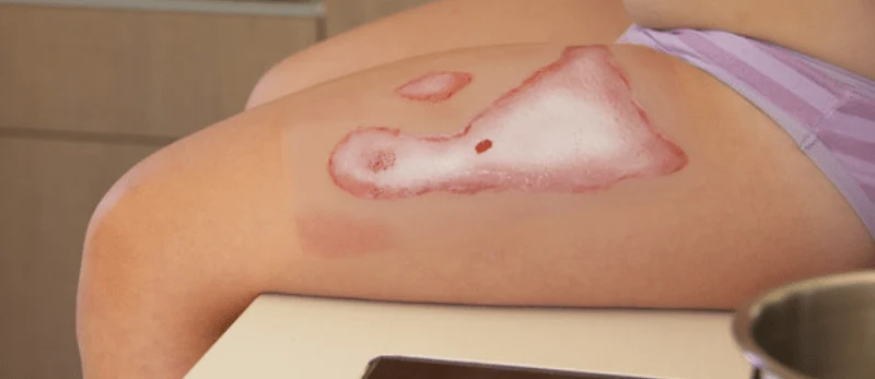 Wundmoulage Verbrühung