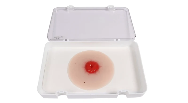 Wundmoulage Kolostoma, selbsthaftend