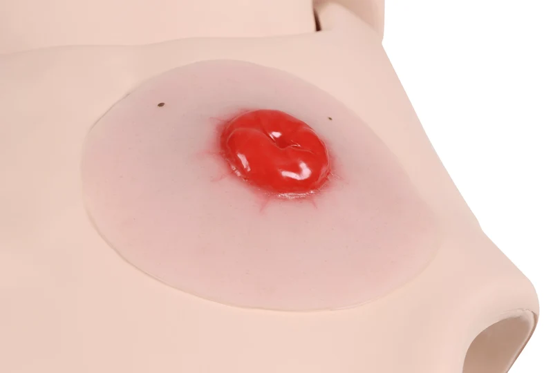 Wundmoulage Kolostoma, selbsthaftend