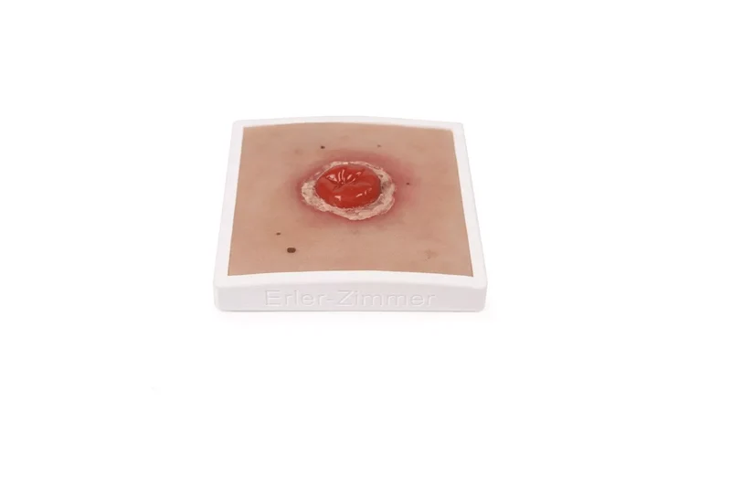 Wundmoulage Kolostoma entzündet, inkl. Stativ