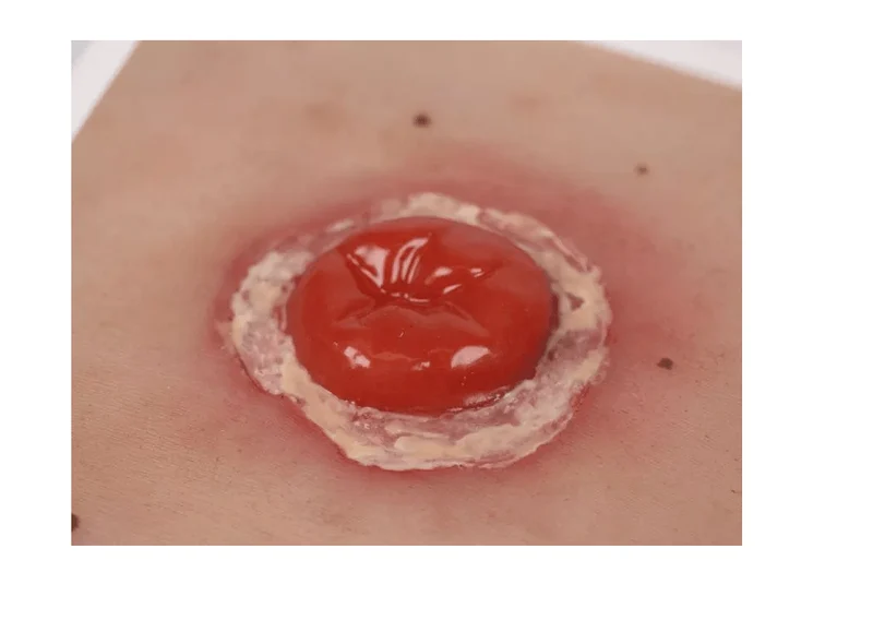 Wundmoulage Kolostoma entzündet, inkl. Stativ