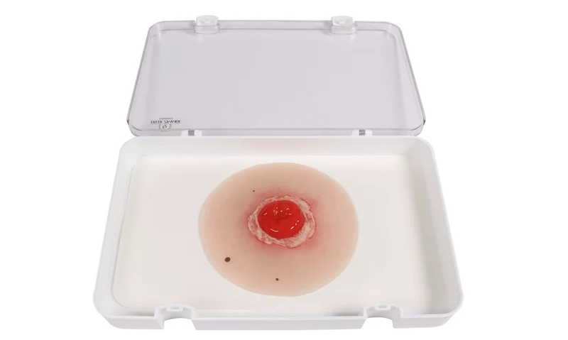 Wundmoulage Kolostoma entzündet, selbsthaftend