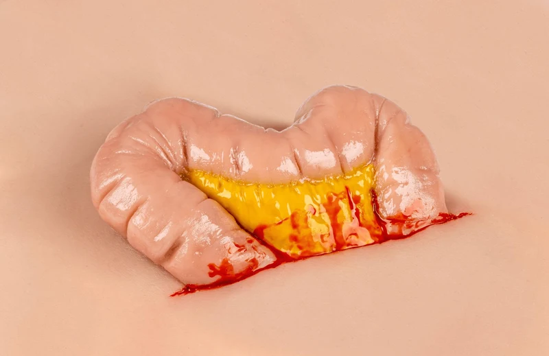 Wundmoulage Dickdarmaustritt