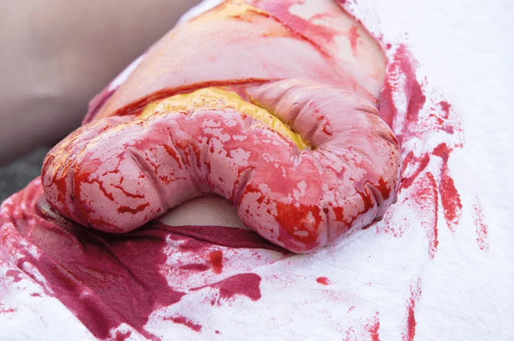 Wundmoulage Dickdarmaustritt