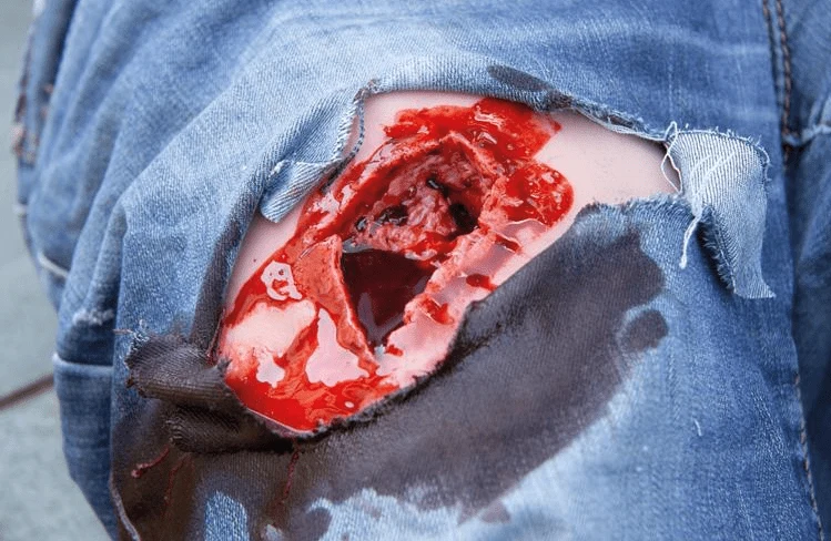 Wundmoulage wound packing