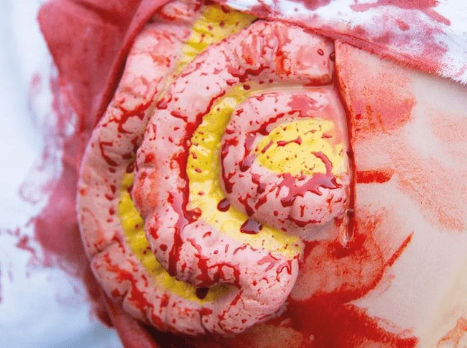Wundmoulage Dünndarmaustritt