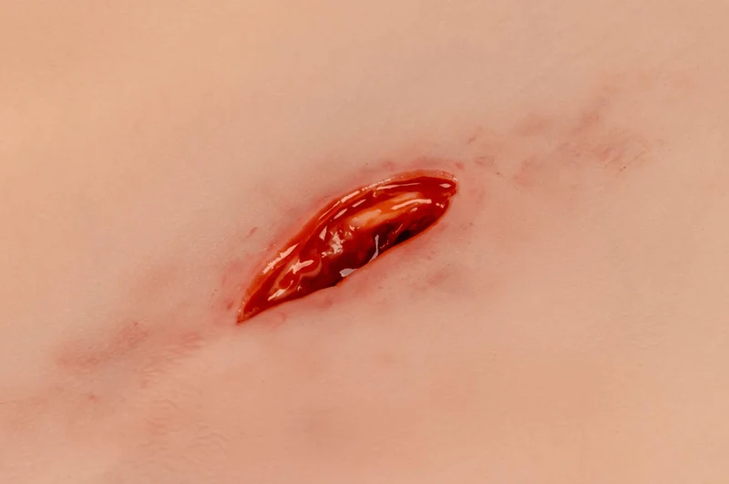 Wundmoulage Stichwunde mit Blutungsfunktion