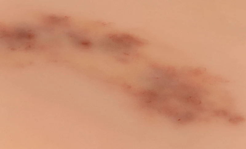 Wundmoulage Hämatom frisch