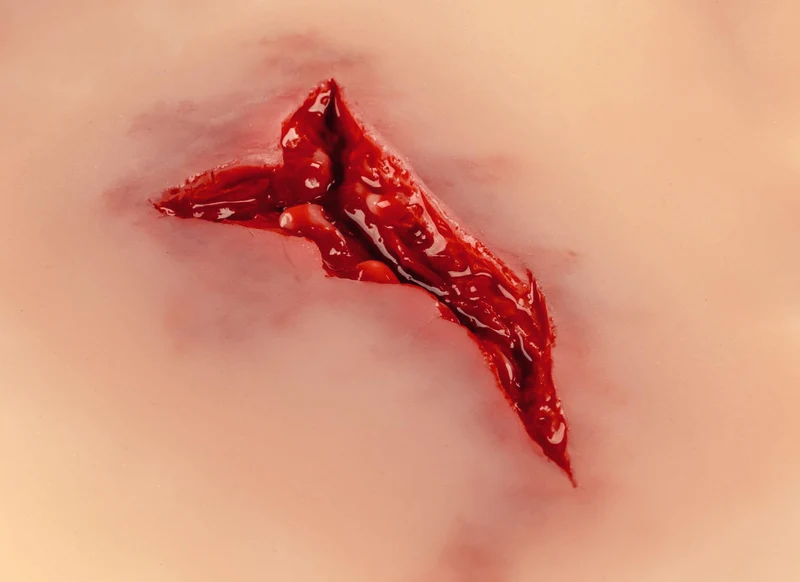 Wundmoulage Risswunde