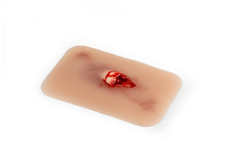 Wundmoulage offener Knochenbruch
