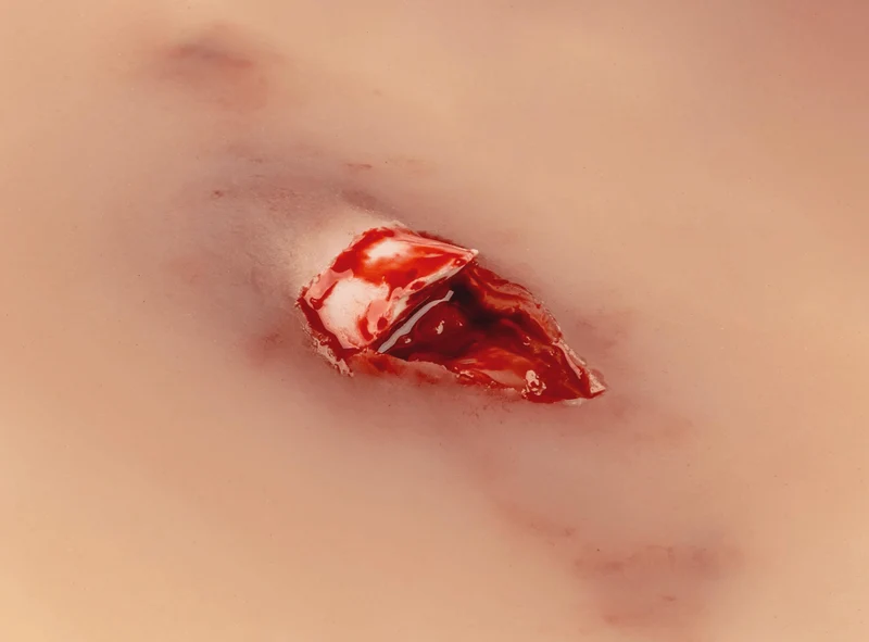 Wundmoulage offener Knochenbruch
