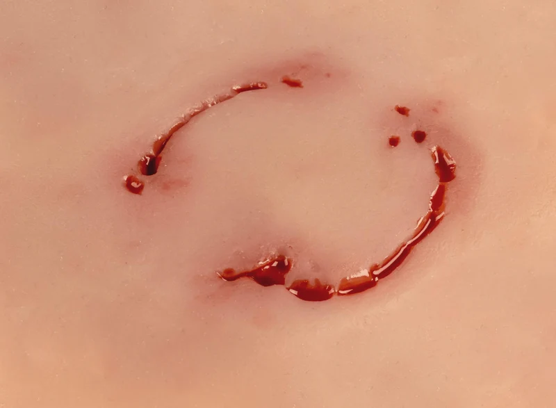 Wundmoulage Bisswunde Mensch