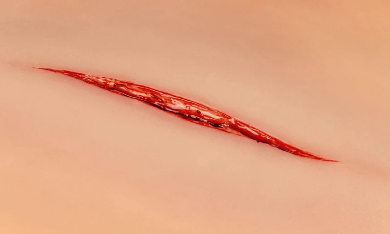 Wundmoulage Halsschnitt