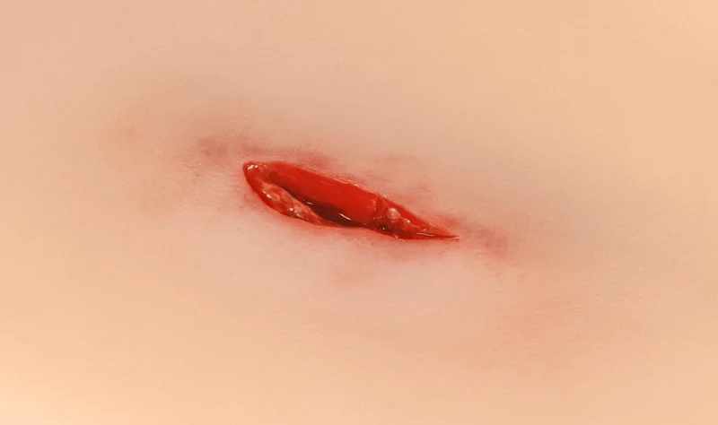 Wundmoulage Stichverletzung Hals