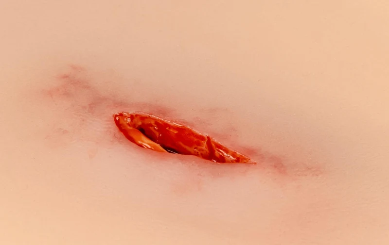 Wundmoulage Stich Oberschenkel