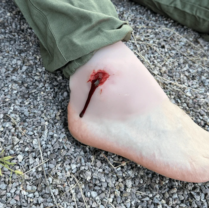 Wundmoulage Schuß Sprunggelenk