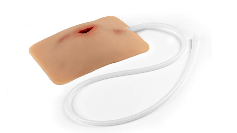Wundmoulage Stich Leiste, Wound Packing