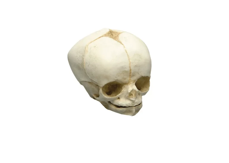 Fetusschädel, 34 Wochen