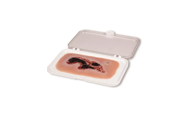 Wundmoulage Ulcus Cruris Arteriosum