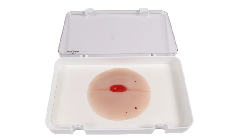 Wundmoulage Kolostoma in Bauchfalte