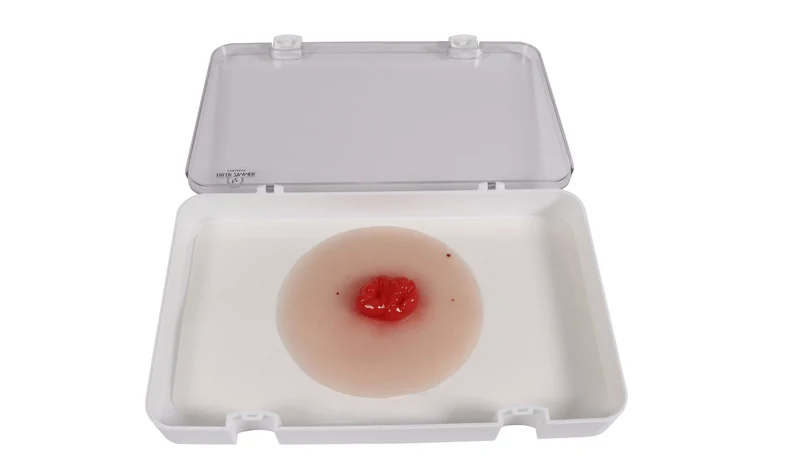 Wundmoulage Kolostoma doppelläufig