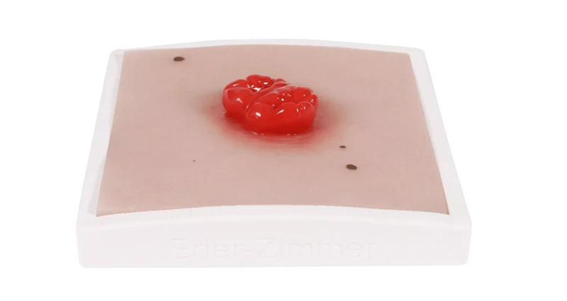 Wundmoulage Kolostoma doppelläufig