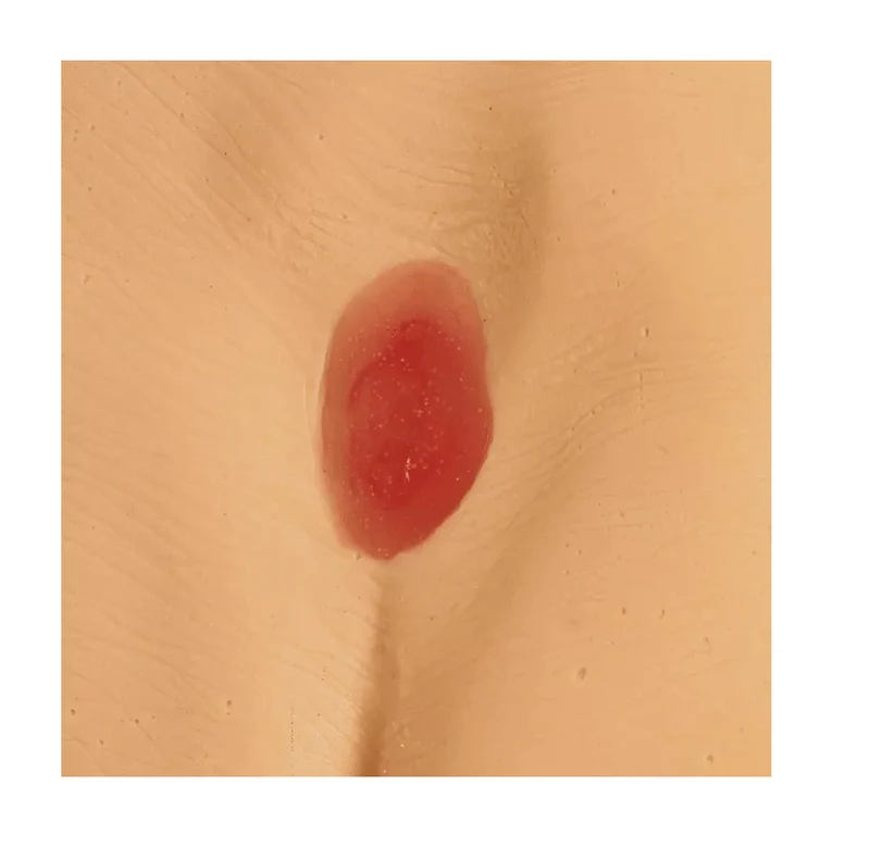 Druckgeschwür / Dekubitus Modelle