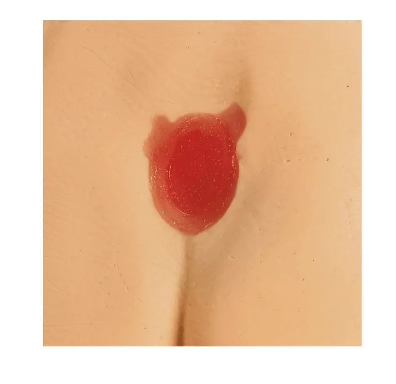 Druckgeschwür / Dekubitus Modelle